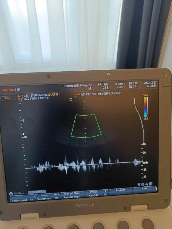 1. kép -  Samsung Medison MySonoU6 hordozható ultrahang készülék hasi vizsgálófejjel